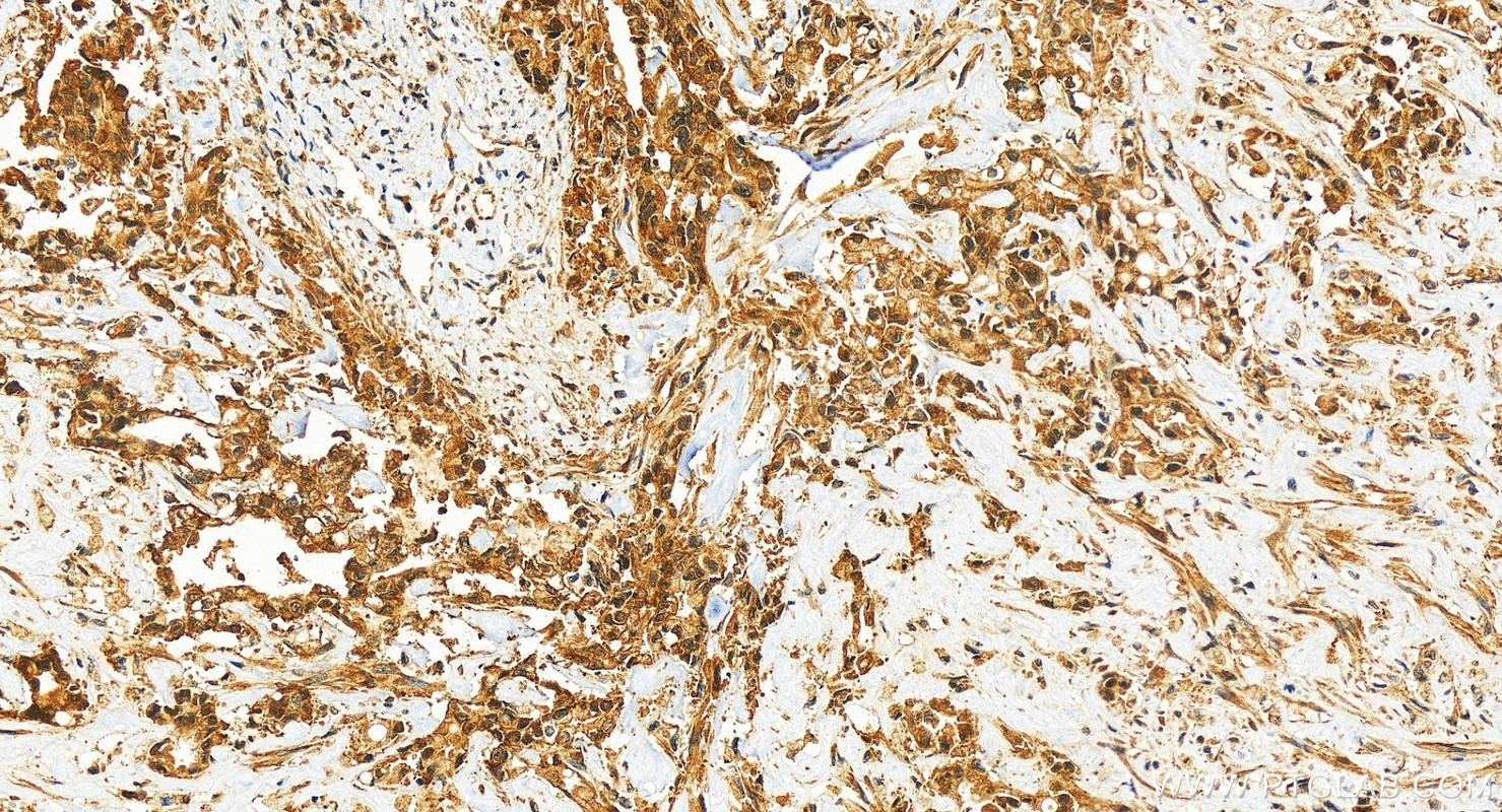 IHC staining of human intrahepatic cholangiocarcinoma using 10126-2-AP