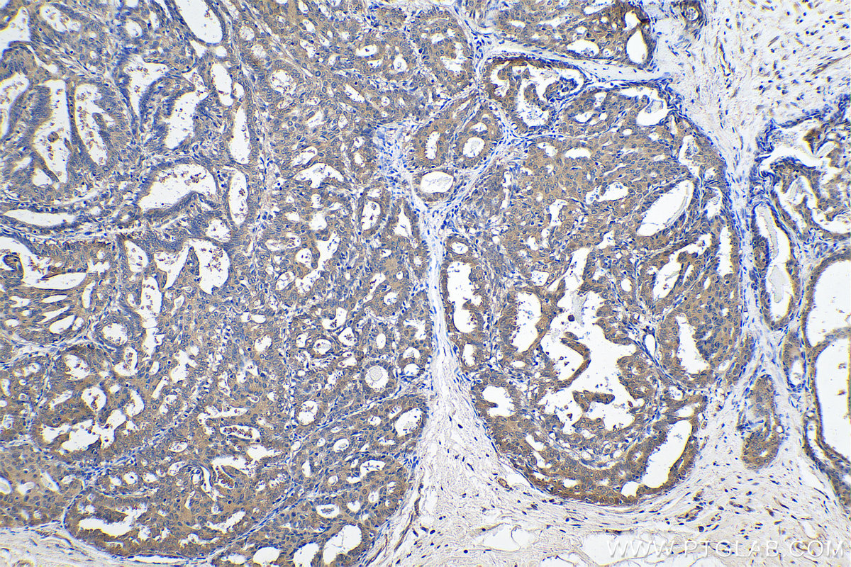 IHC staining of human breast cancer using 10126-2-AP