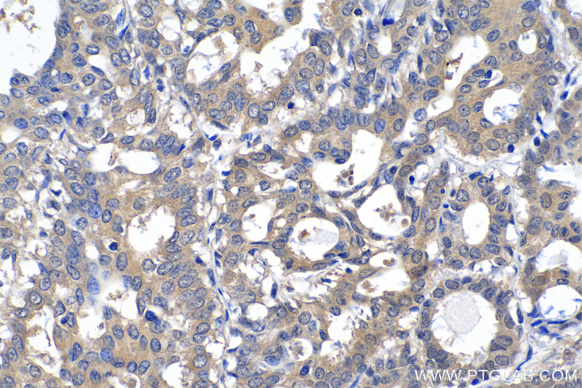 IHC staining of human breast cancer using 10126-2-AP