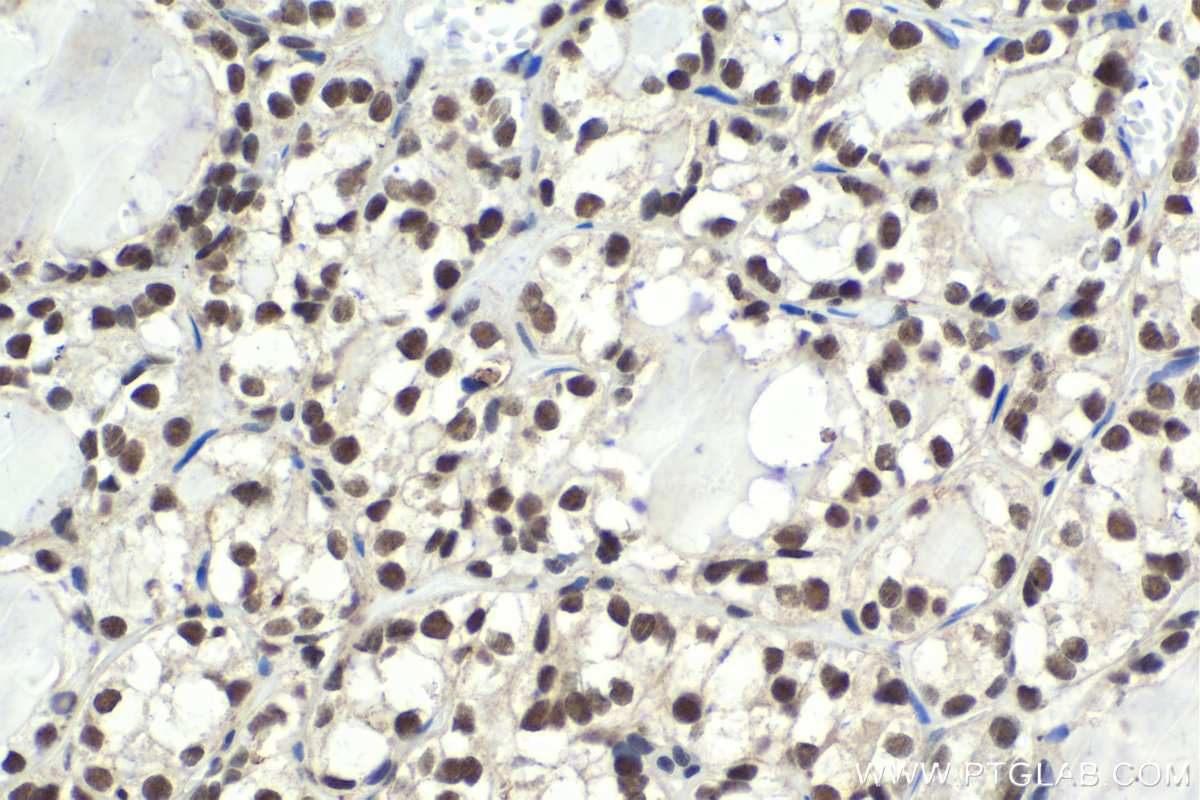 IHC staining of human thyroid cancer using 11609-1-AP