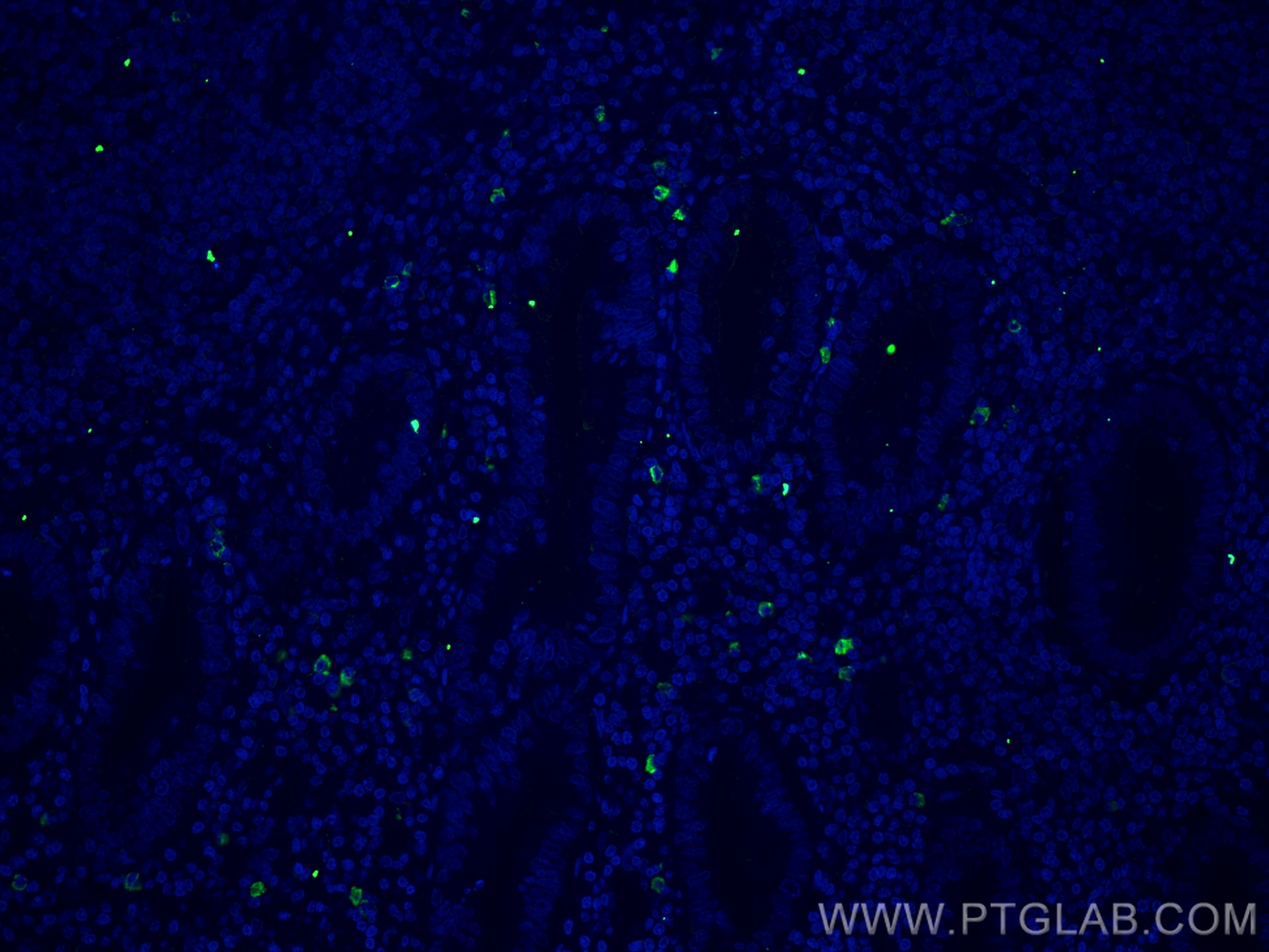 IF Staining of human appendicitis using 68033-1-Ig (same clone as 68033-1-PBS)