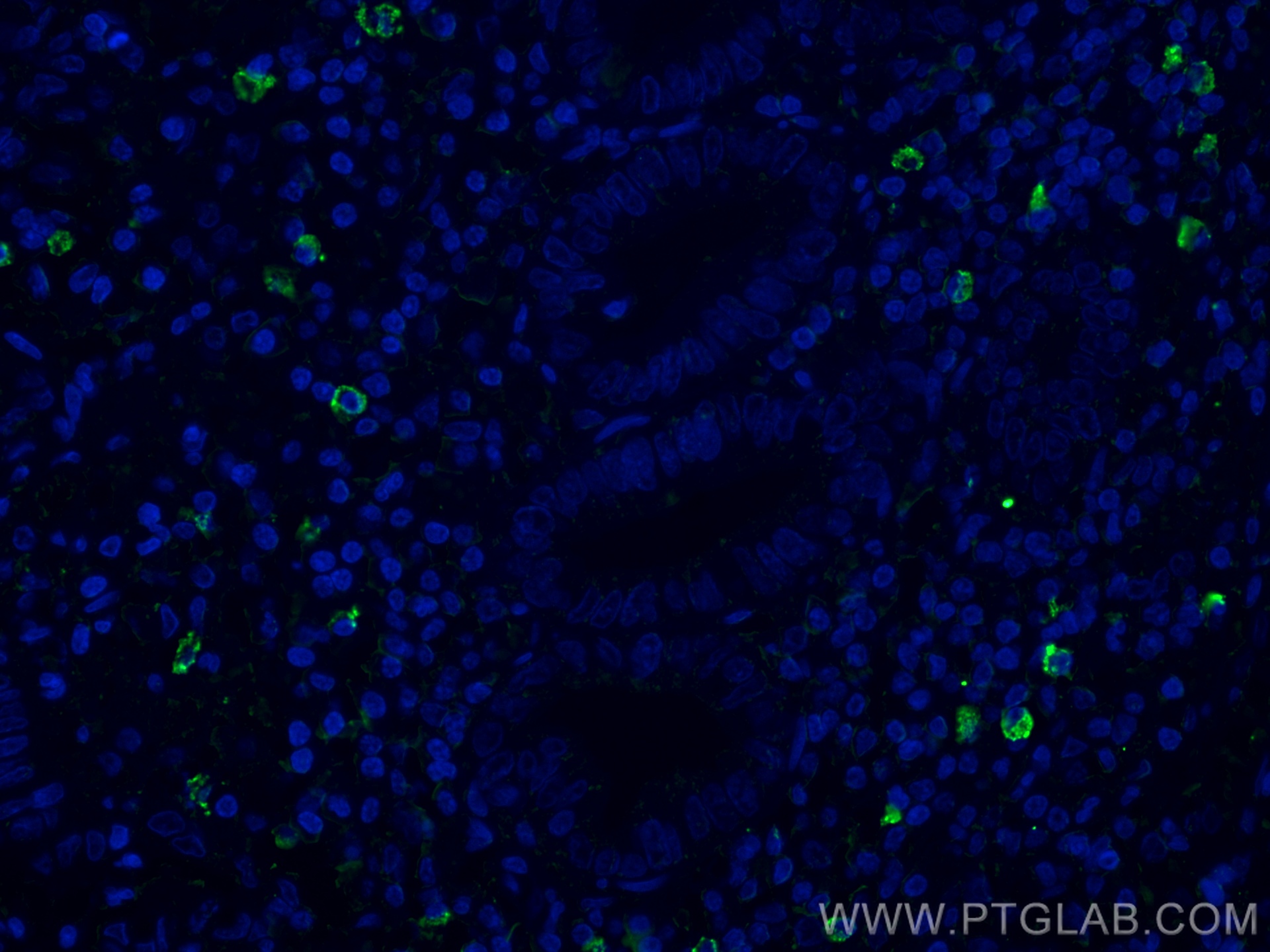 IF Staining of human appendicitis using 68033-1-Ig (same clone as 68033-1-PBS)