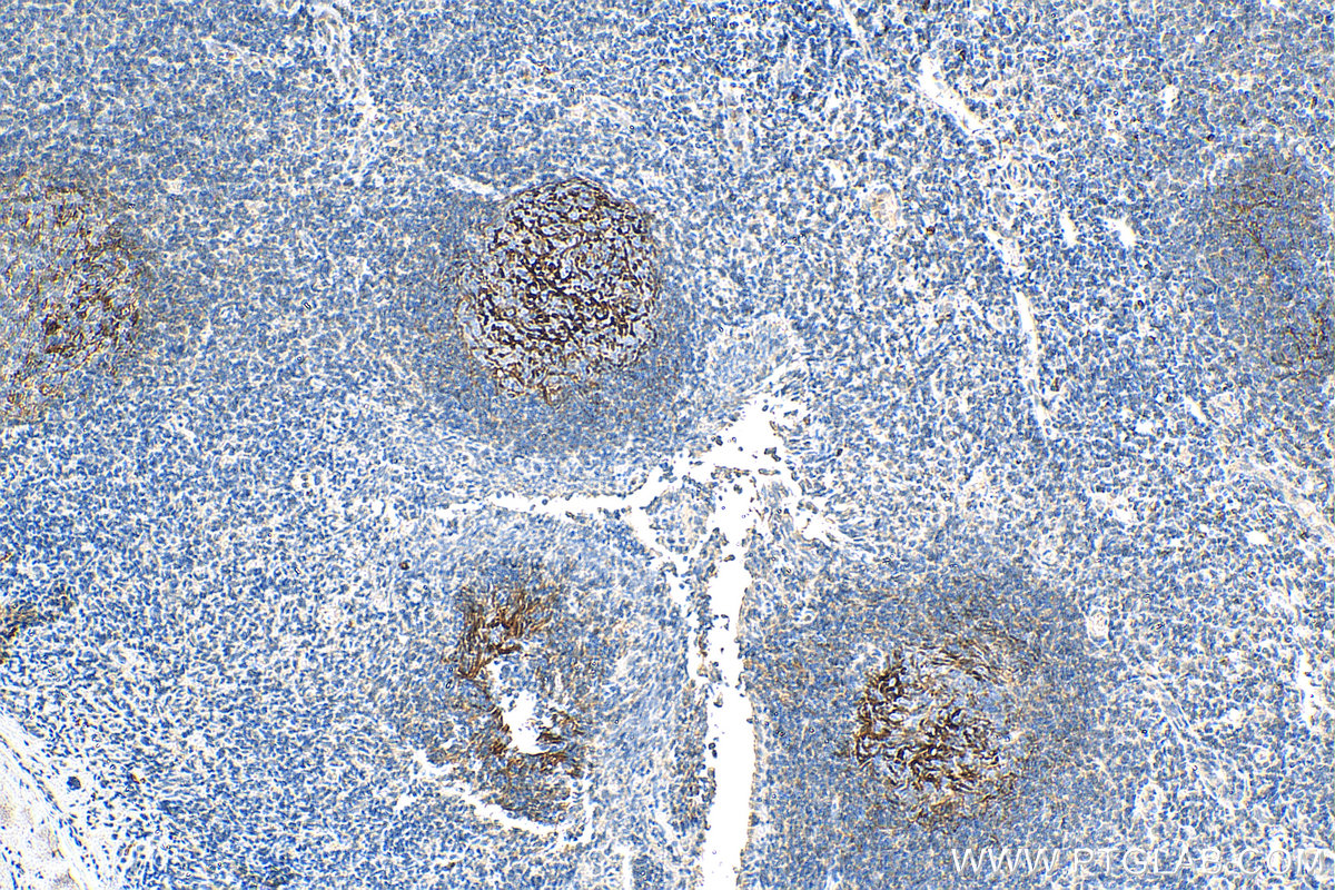 IHC staining of human tonsillitis using 68033-1-Ig (same clone as 68033-1-PBS)