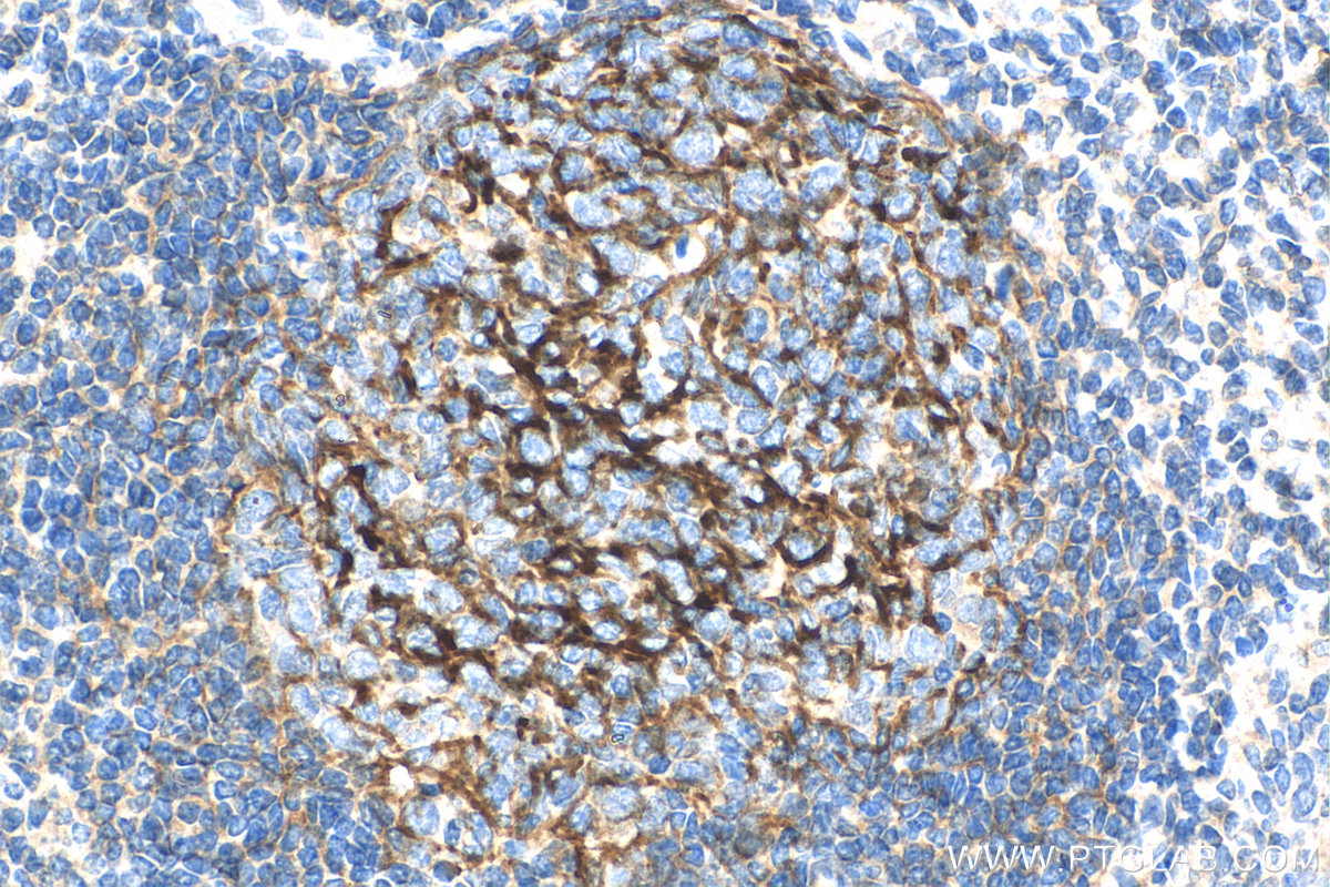 IHC staining of human tonsillitis using 68033-1-Ig (same clone as 68033-1-PBS)