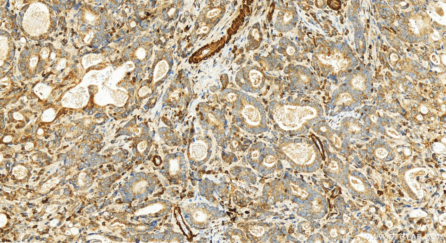 IHC staining of human stomach cancer using 15349-1-AP