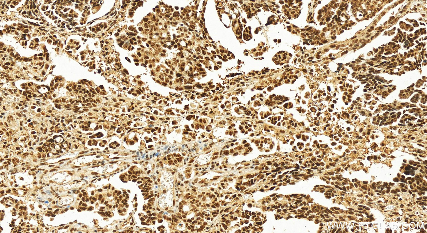 IHC staining of human ovary cancer using 14504-1-AP