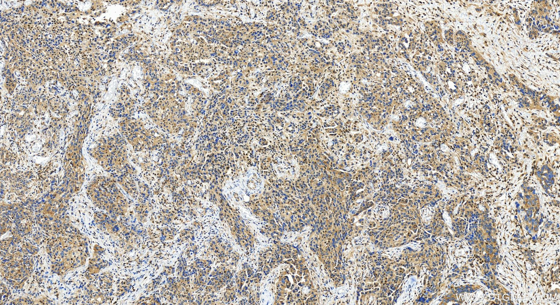 IHC staining of human ovary cancer using 27647-1-AP