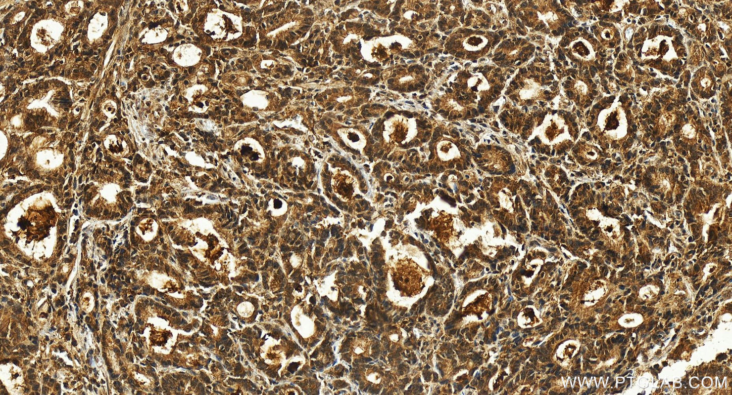 IHC staining of human stomach cancer using 25476-1-AP