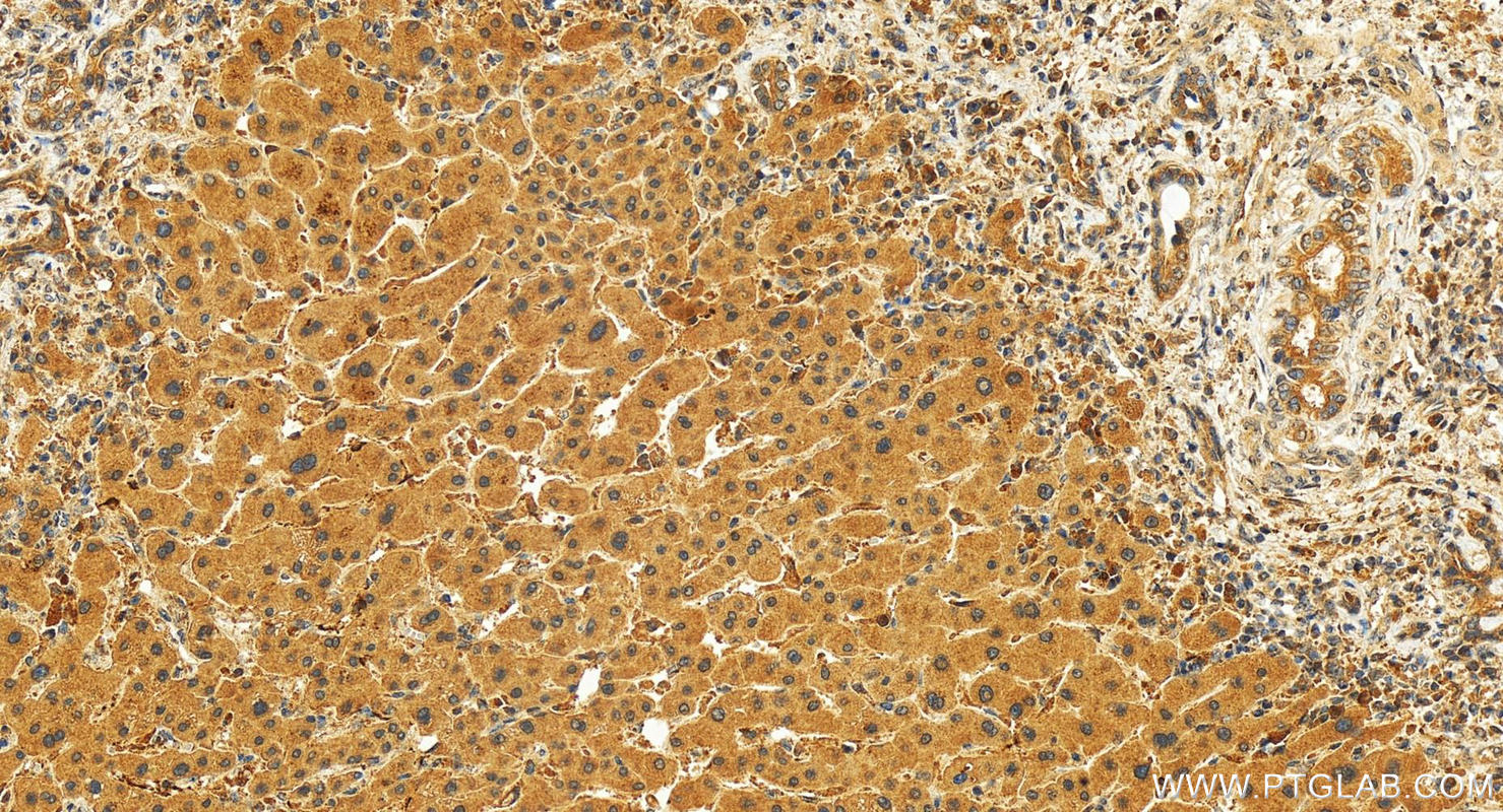 IHC staining of human intrahepatic cholangiocarcinoma using 25476-1-AP