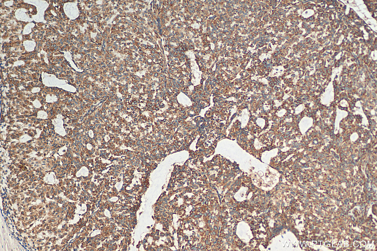 IHC staining of human breast hyperplasia using 30498-1-AP (same clone as 30498-1-PBS)