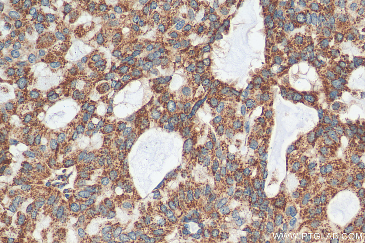 IHC staining of human breast hyperplasia using 30498-1-AP (same clone as 30498-1-PBS)