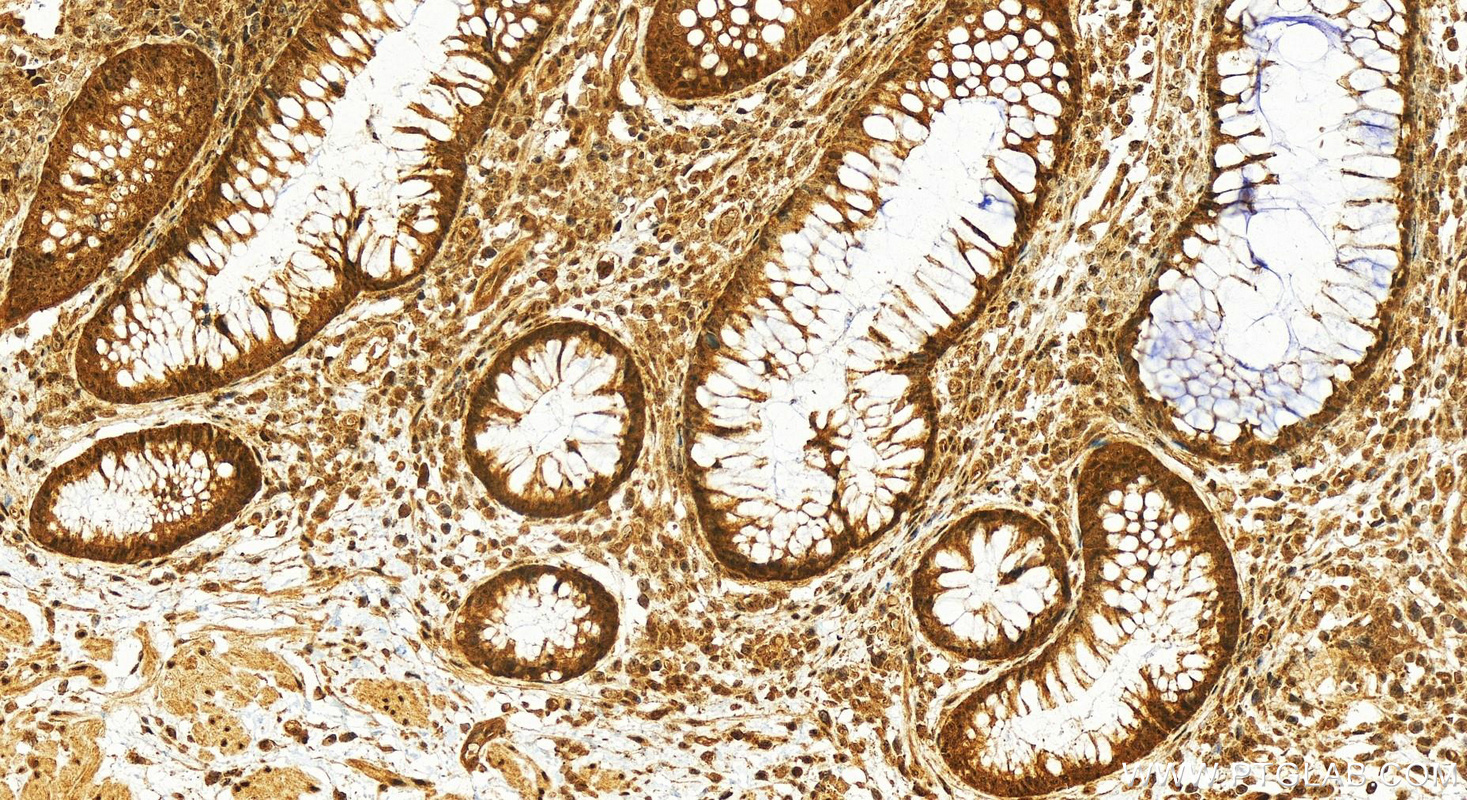 IHC staining of human colon cancer using 10992-1-AP