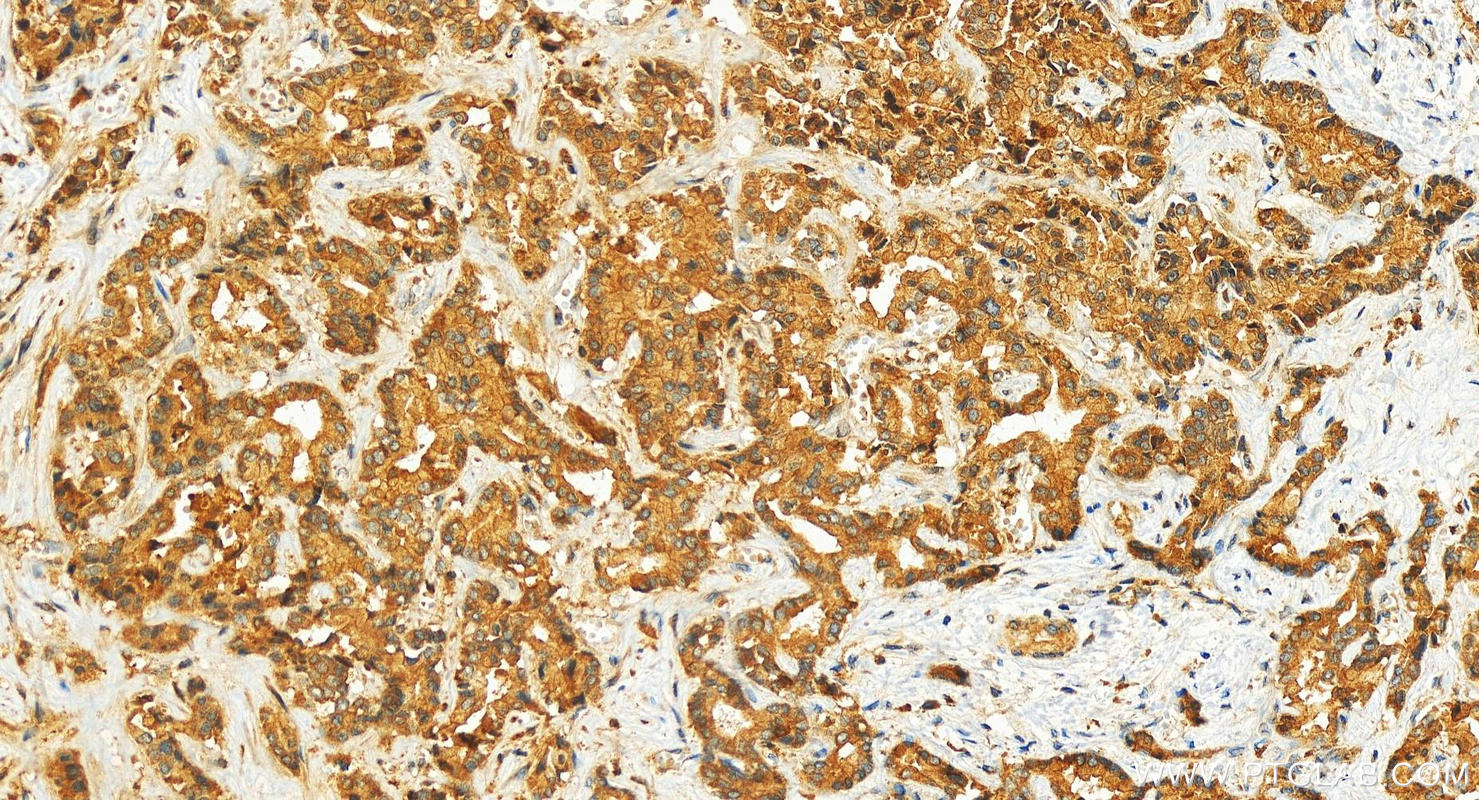 IHC staining of human intrahepatic cholangiocarcinoma using 15962-1-AP