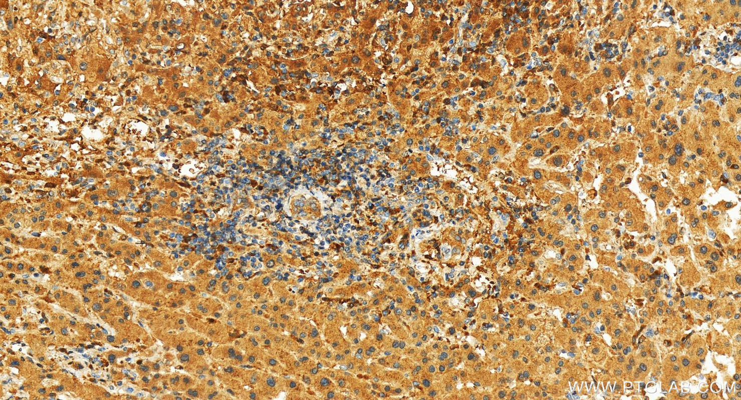 IHC staining of human intrahepatic cholangiocarcinoma using 15962-1-AP