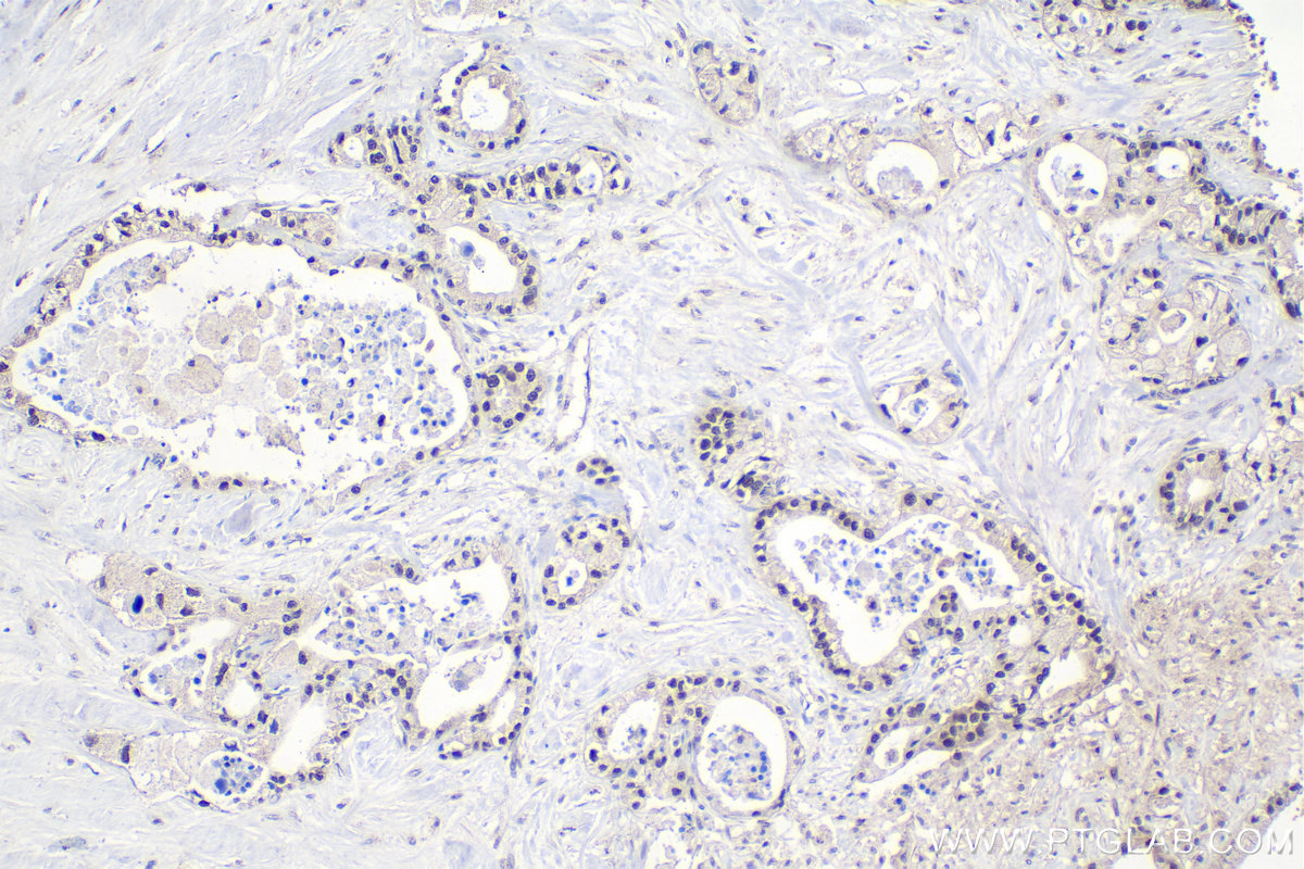 IHC staining of human pancreas cancer using 10346-1-AP