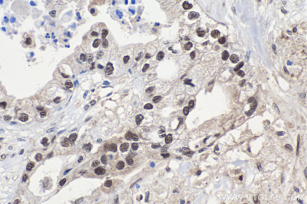 IHC staining of human pancreas cancer using 10346-1-AP