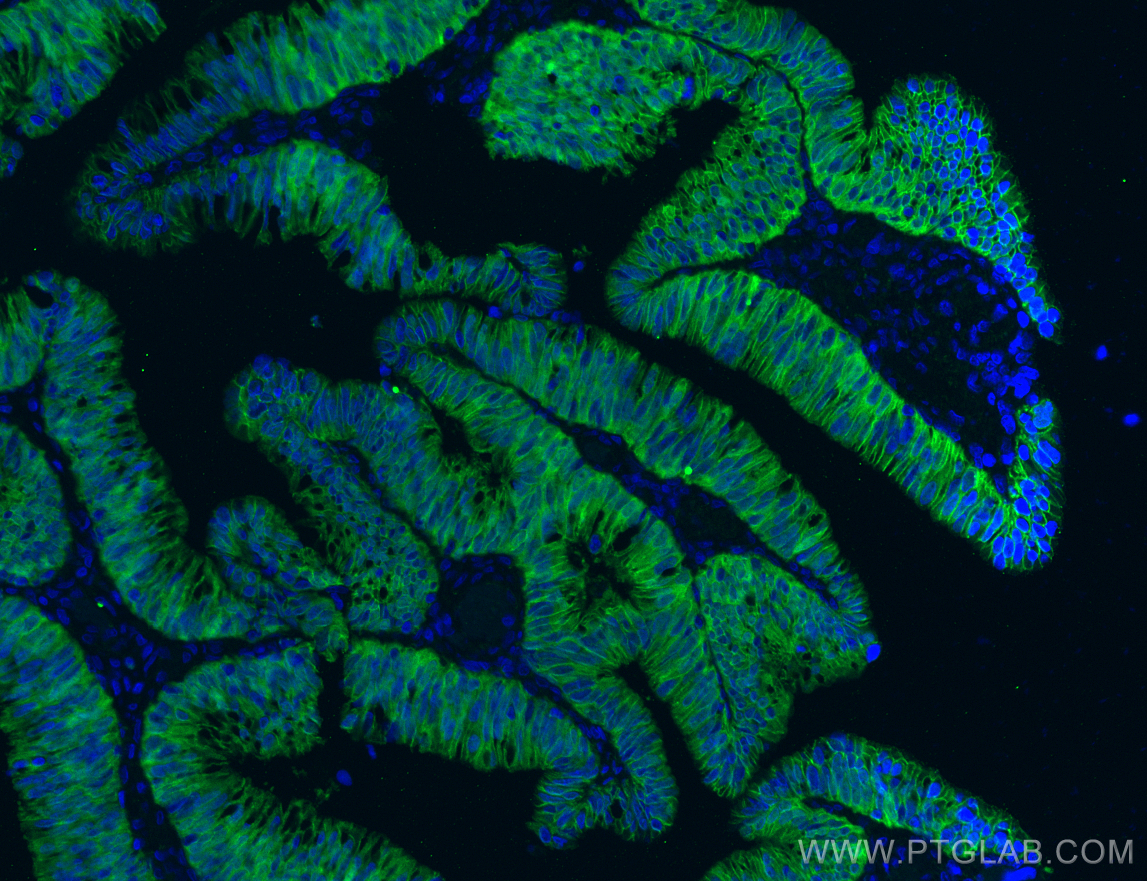 IF Staining of human colon cancer using 66379-1-Ig