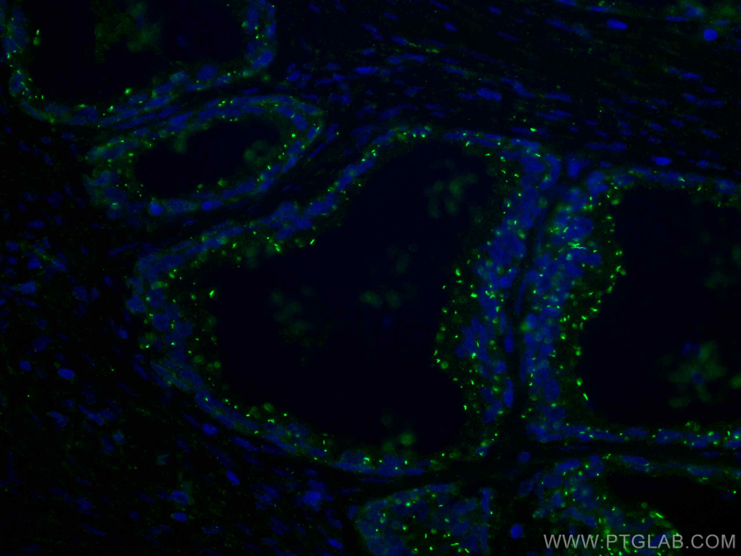 IF Staining of human prostate cancer using 67734-1-Ig (same clone as 67734-1-PBS)