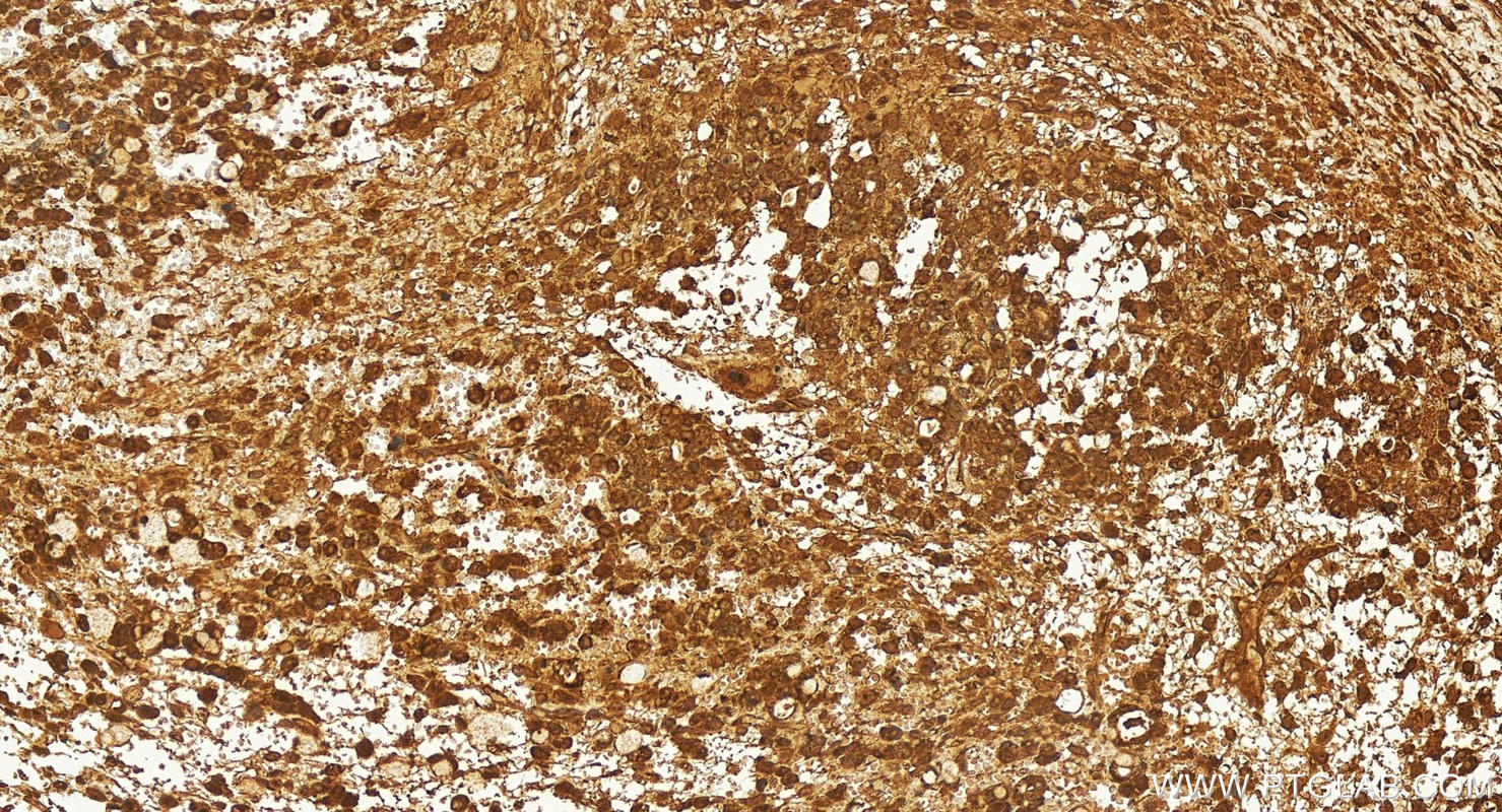 IHC staining of human ovary cancer using 25523-1-AP