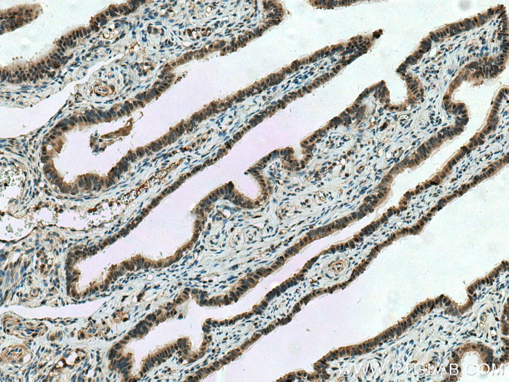 IHC staining of human ovary tumor using 20123-1-AP