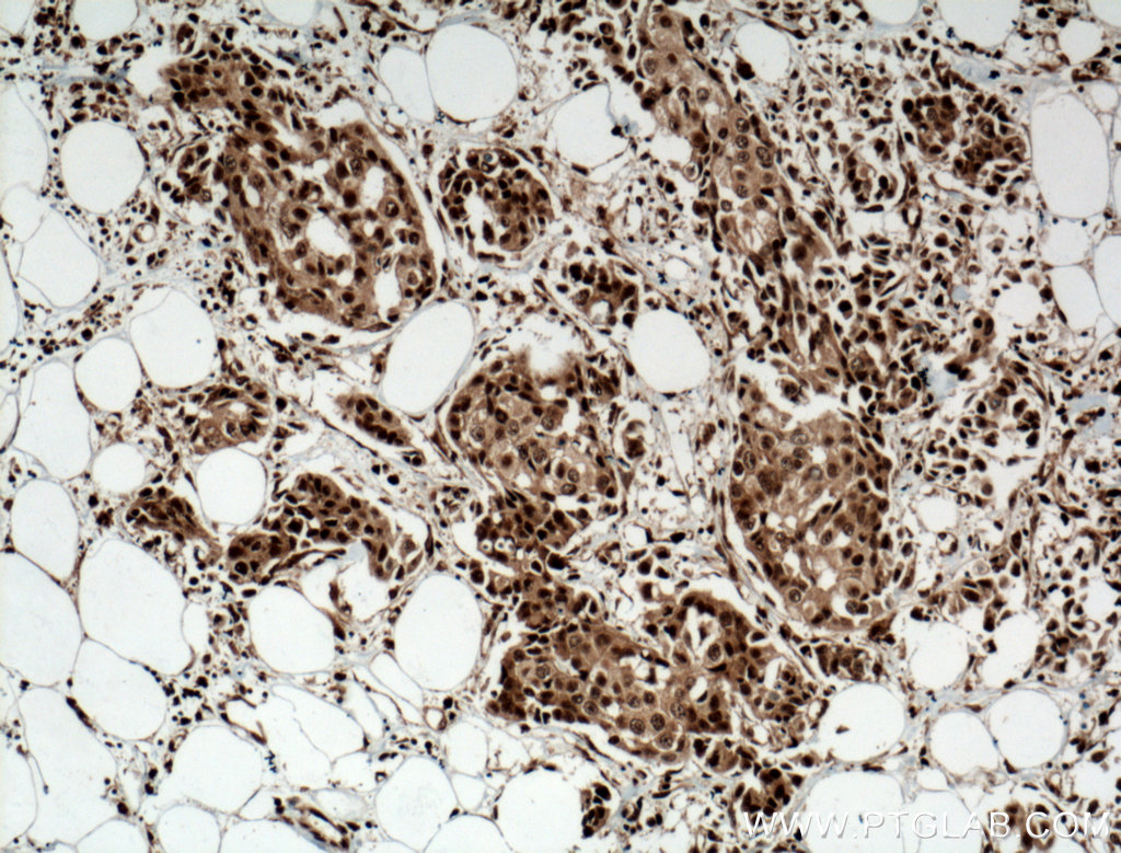 IHC staining of human breast cancer using 12921-1-AP