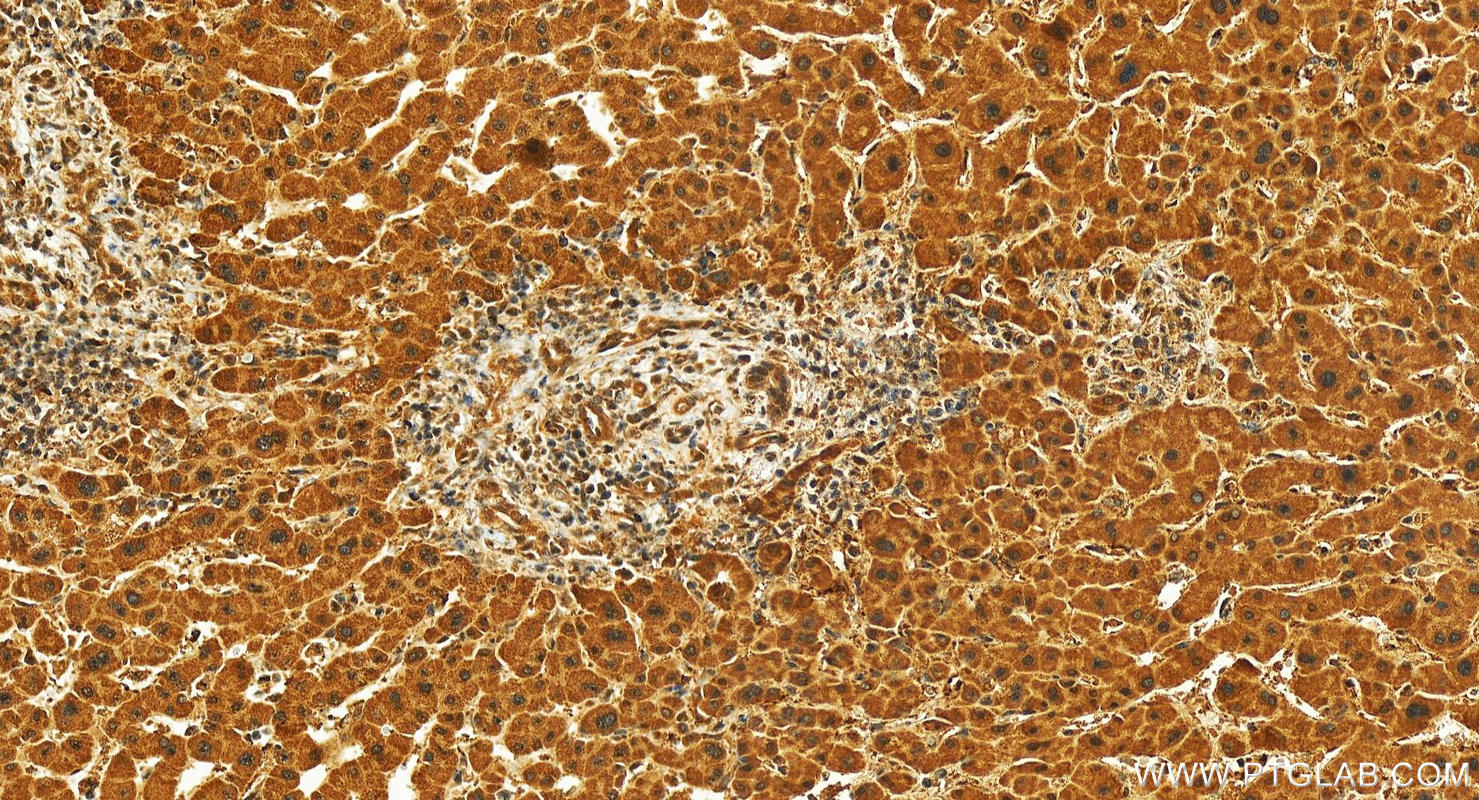 IHC staining of human intrahepatic cholangiocarcinoma using 26898-1-AP