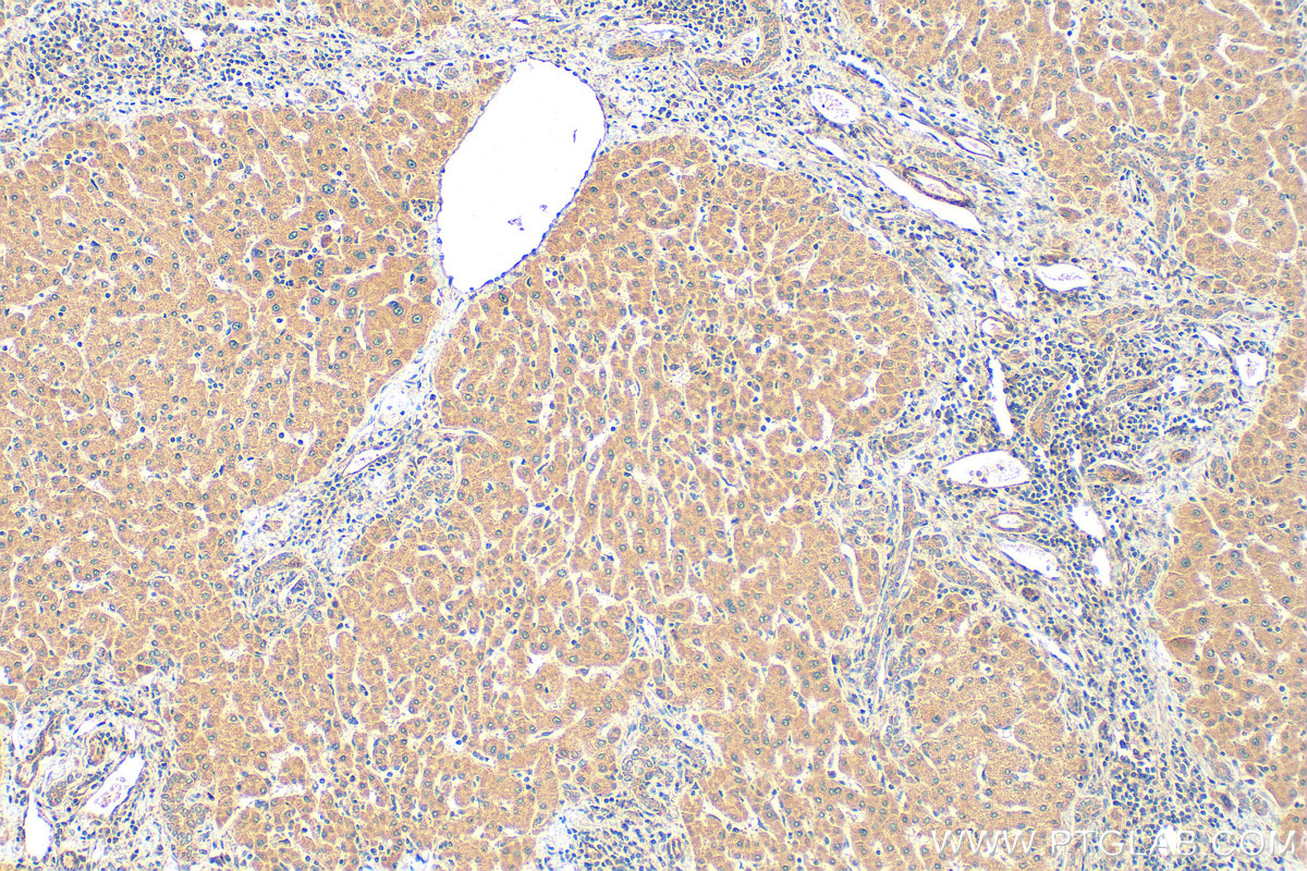 IHC staining of human hepatocirrhosis using 10937-1-AP