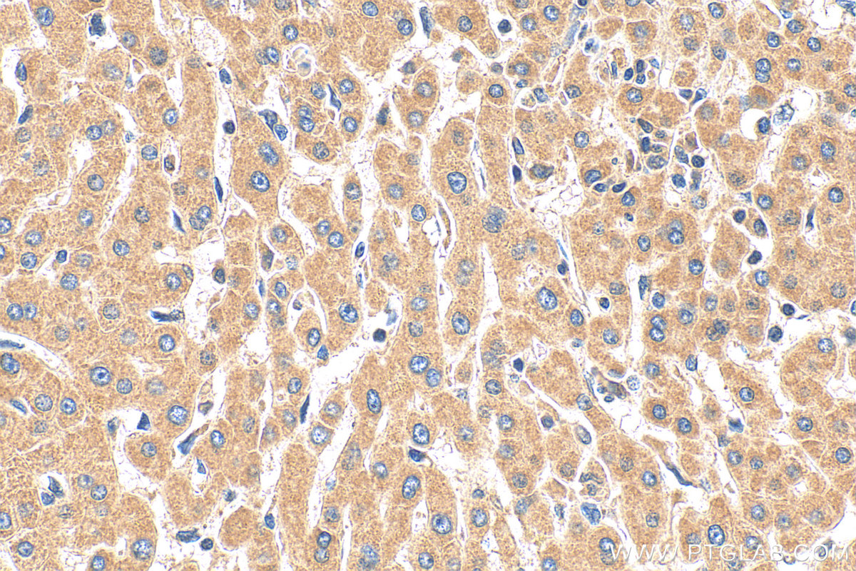 IHC staining of human hepatocirrhosis using 10937-1-AP