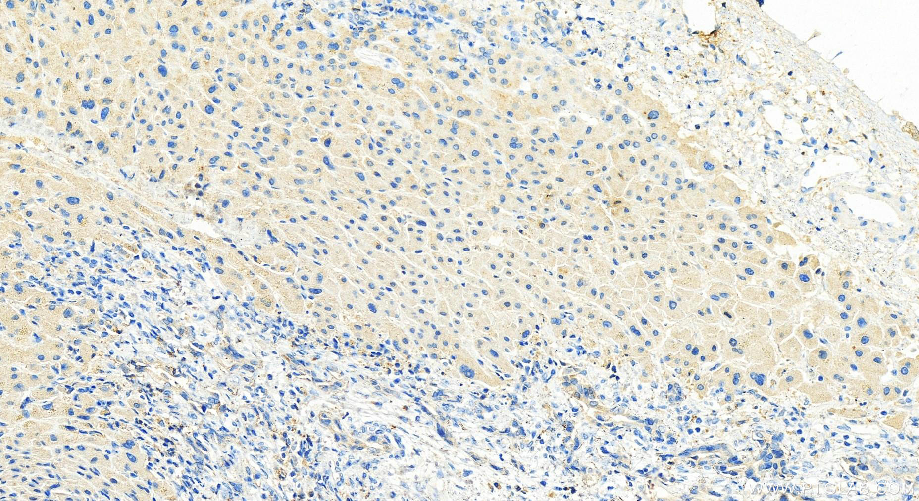 IHC staining of human intrahepatic cholangiocarcinoma using 10809-1-AP