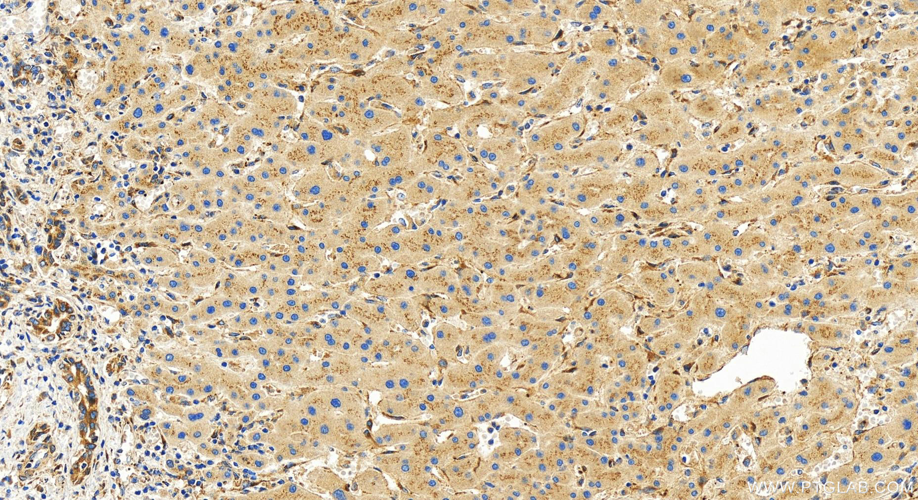 IHC staining of human intrahepatic cholangiocarcinoma using 31533-1-AP