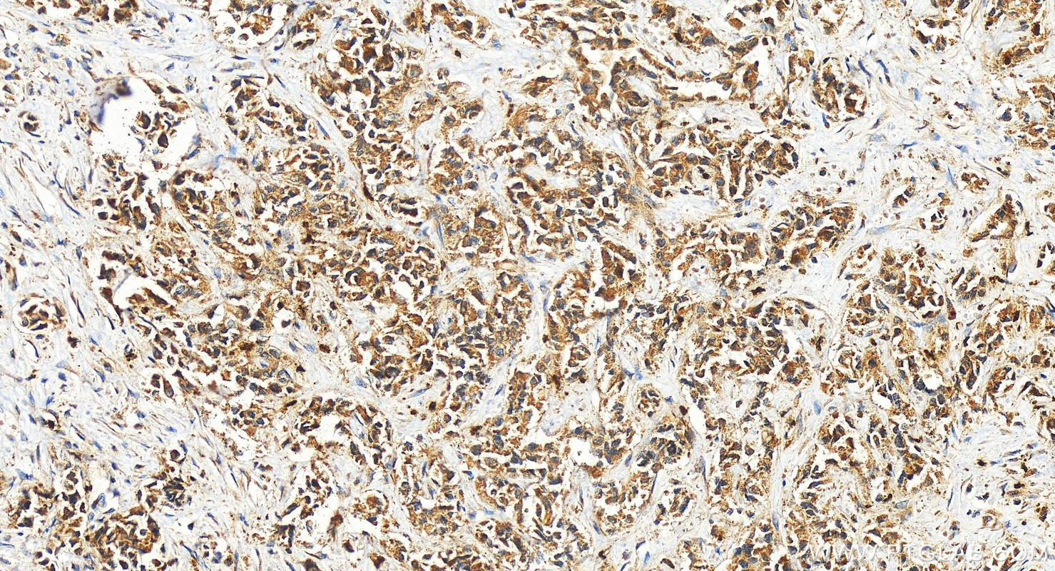 IHC staining of human intrahepatic cholangiocarcinoma using 27095-1-AP