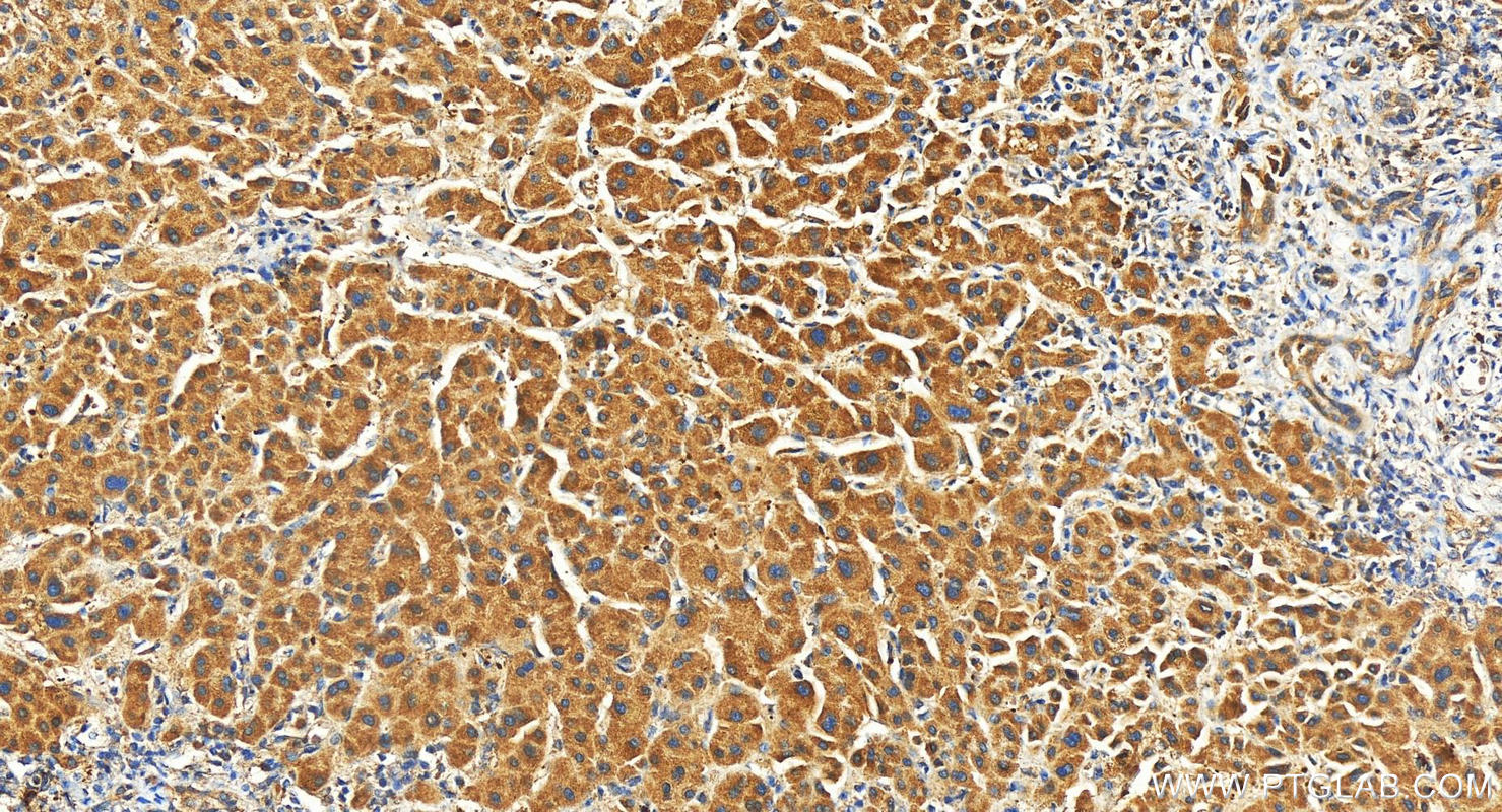 IHC staining of human intrahepatic cholangiocarcinoma using 27095-1-AP