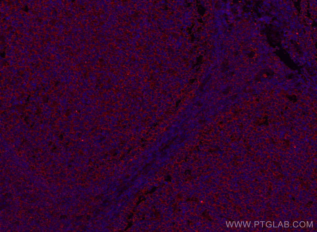 IF Staining of human tonsillitis using 60065-1-Ig