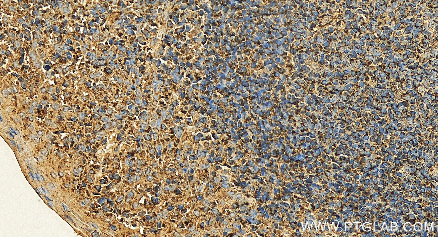 IHC staining of human tonsillitis using 60042-1-Ig