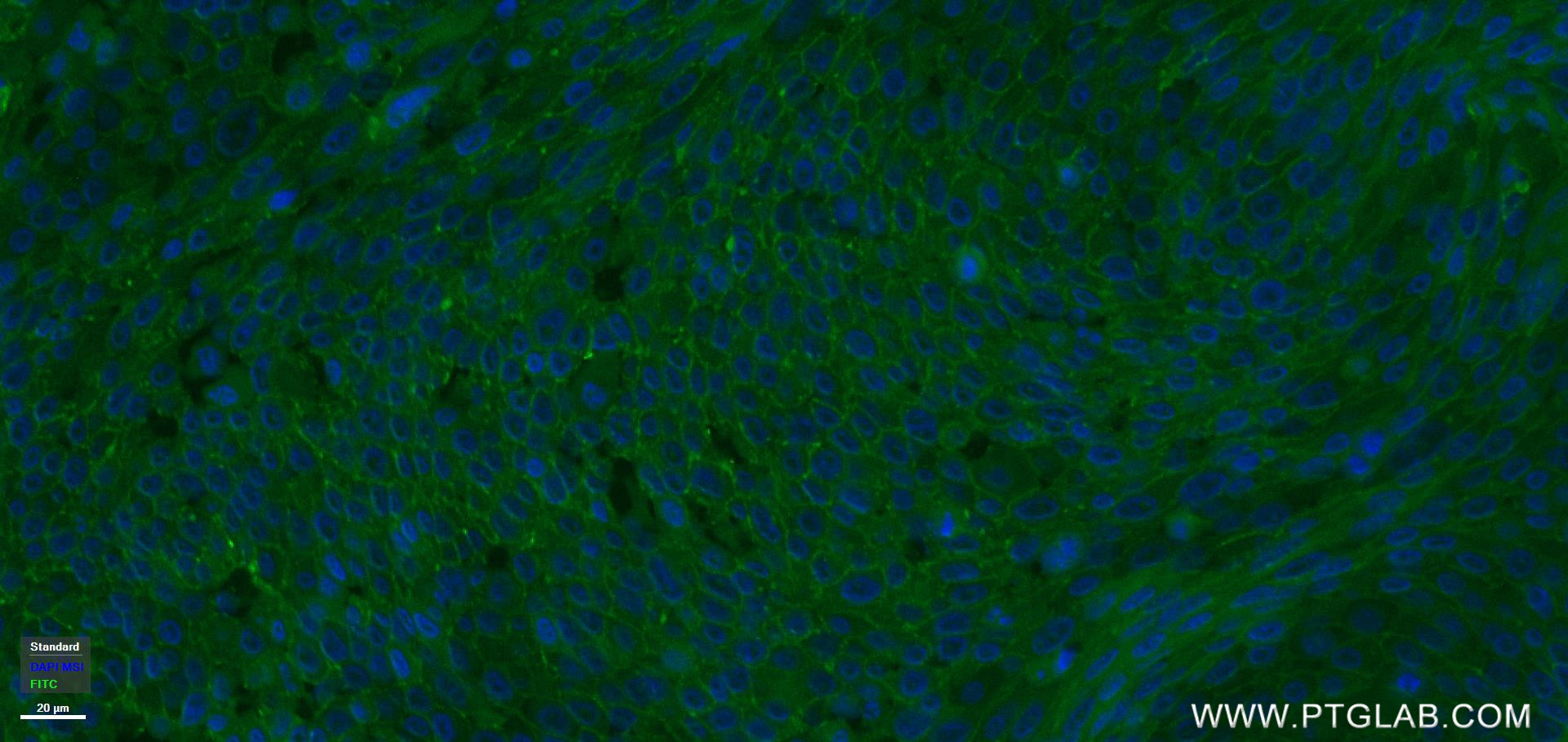 IF Staining of human lung cancer using 84591-1-RR (same clone as 84591-1-PBS)