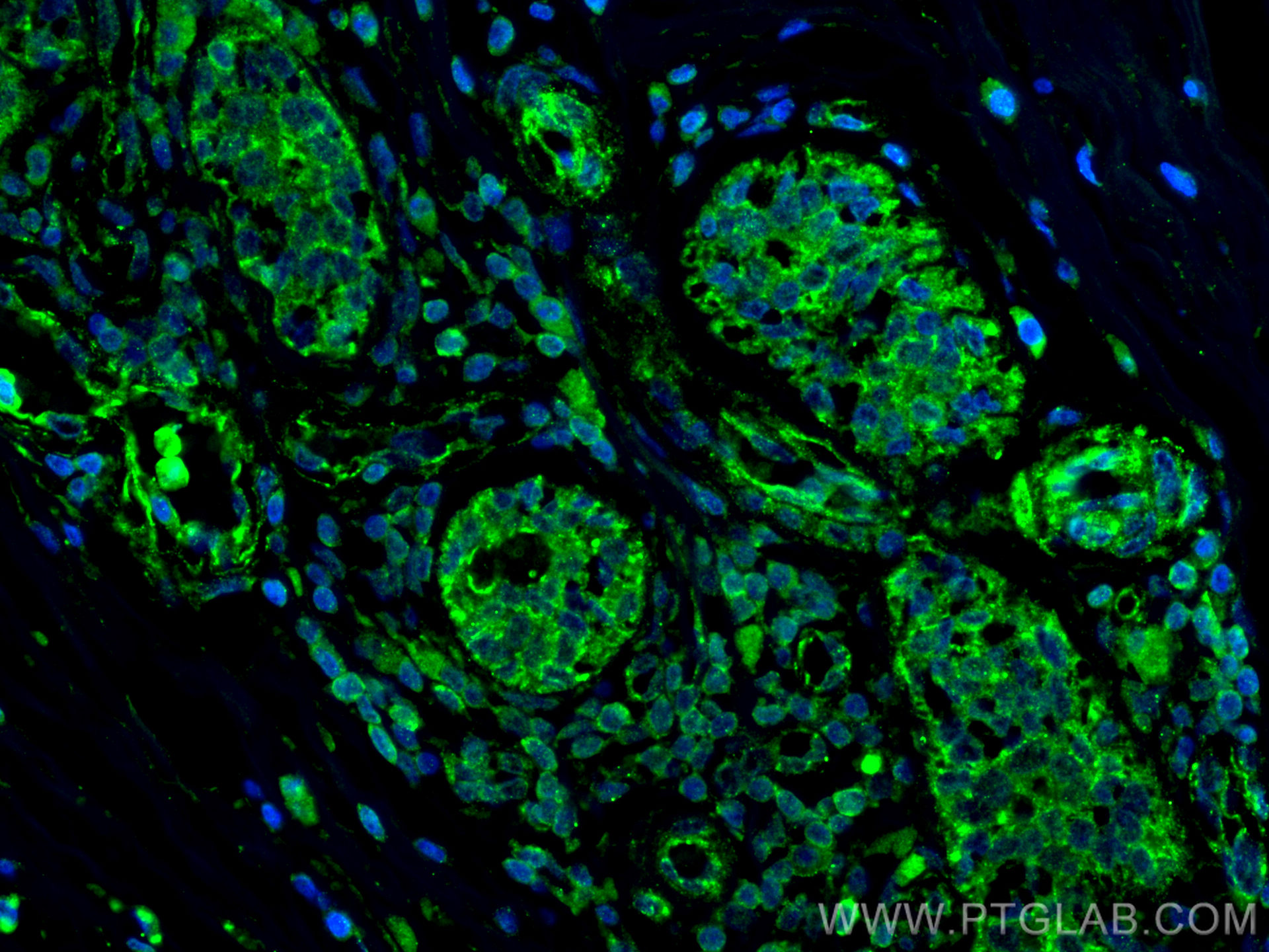 IF Staining of human breast cancer using 60216-1-Ig
