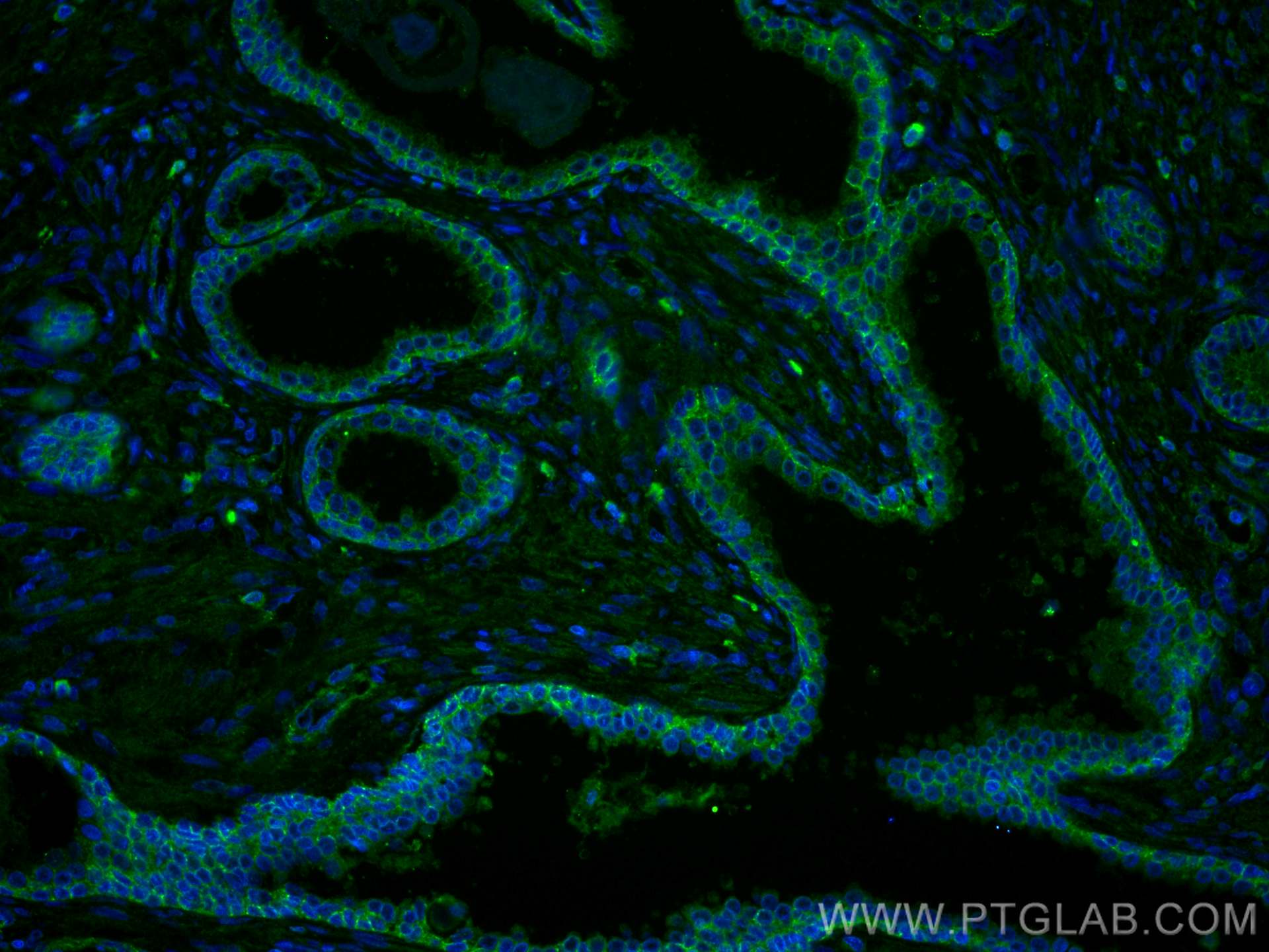 IF Staining of human prostate cancer using 60216-1-Ig (same clone as 60216-1-PBS)