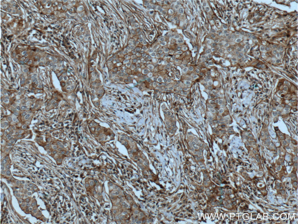 IHC staining of human breast cancer using 60216-1-Ig (same clone as 60216-1-PBS)
