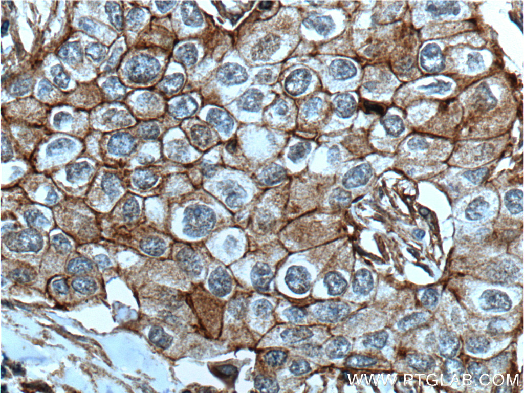 IHC staining of human breast cancer using 60216-1-Ig (same clone as 60216-1-PBS)