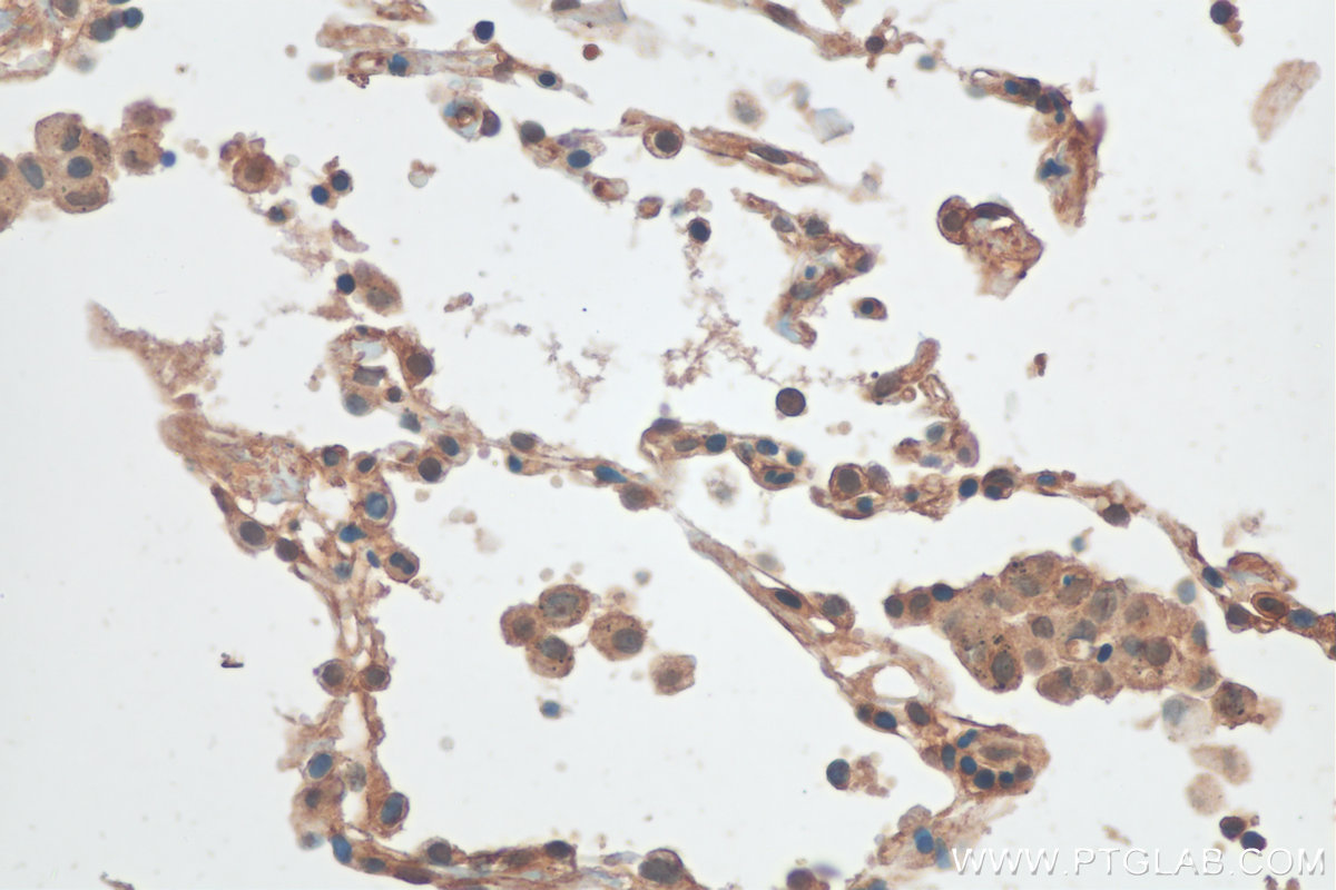 IHC staining of human lung cancer using 20837-1-AP