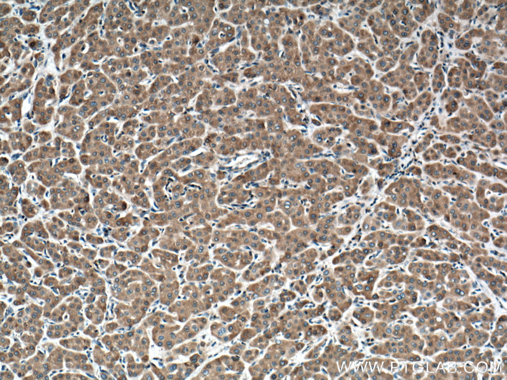 IHC staining of human liver cancer using 12365-1-AP