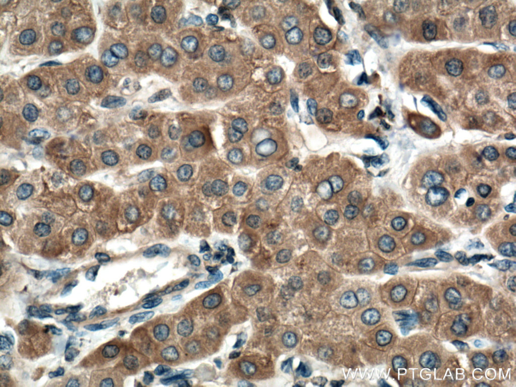 IHC staining of human liver cancer using 12365-1-AP