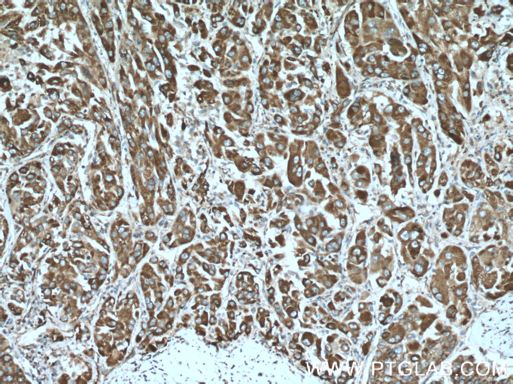 IHC staining of human liver cancer using 66022-1-Ig (same clone as 66022-1-PBS)