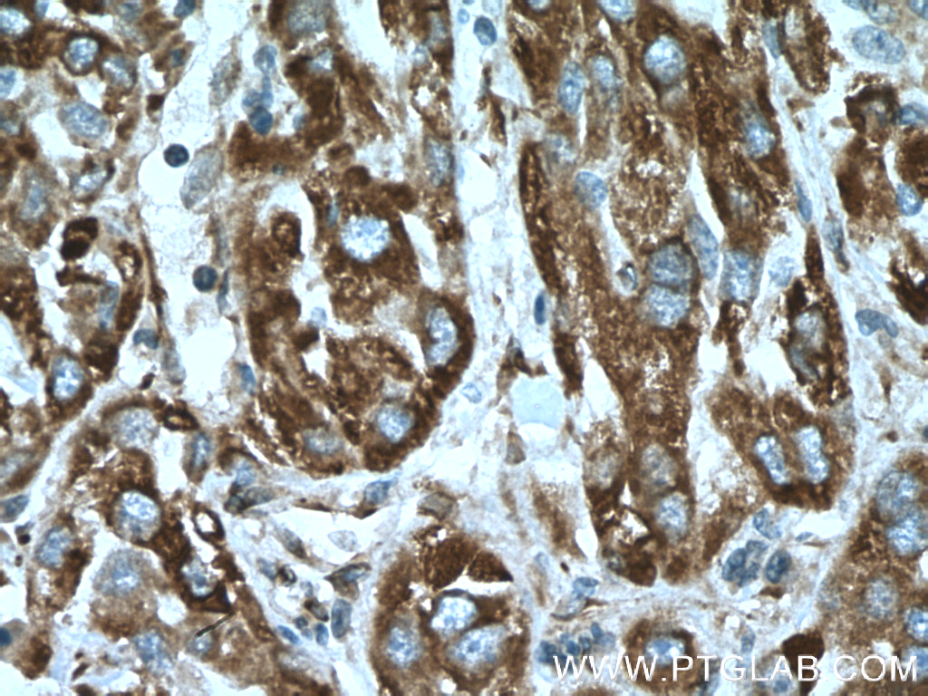 IHC staining of human liver cancer using 66022-1-Ig (same clone as 66022-1-PBS)