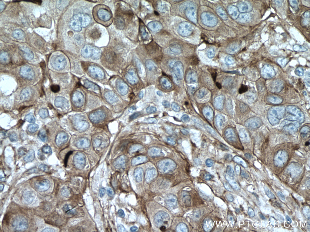 IHC staining of human breast cancer using 26735-1-AP