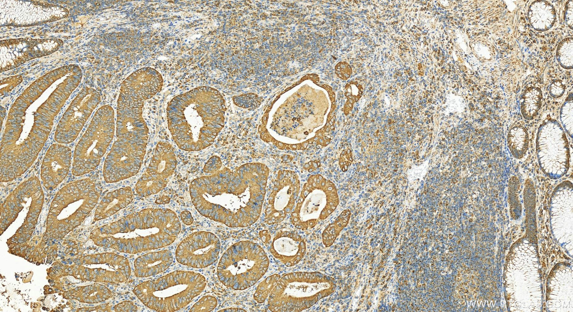 IHC staining of human colon cancer using 10993-1-AP