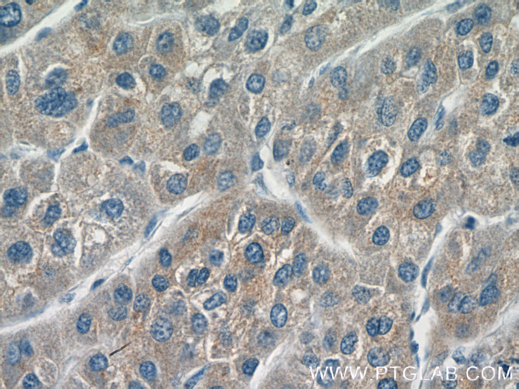 IHC staining of human liver cancer using 16702-1-AP