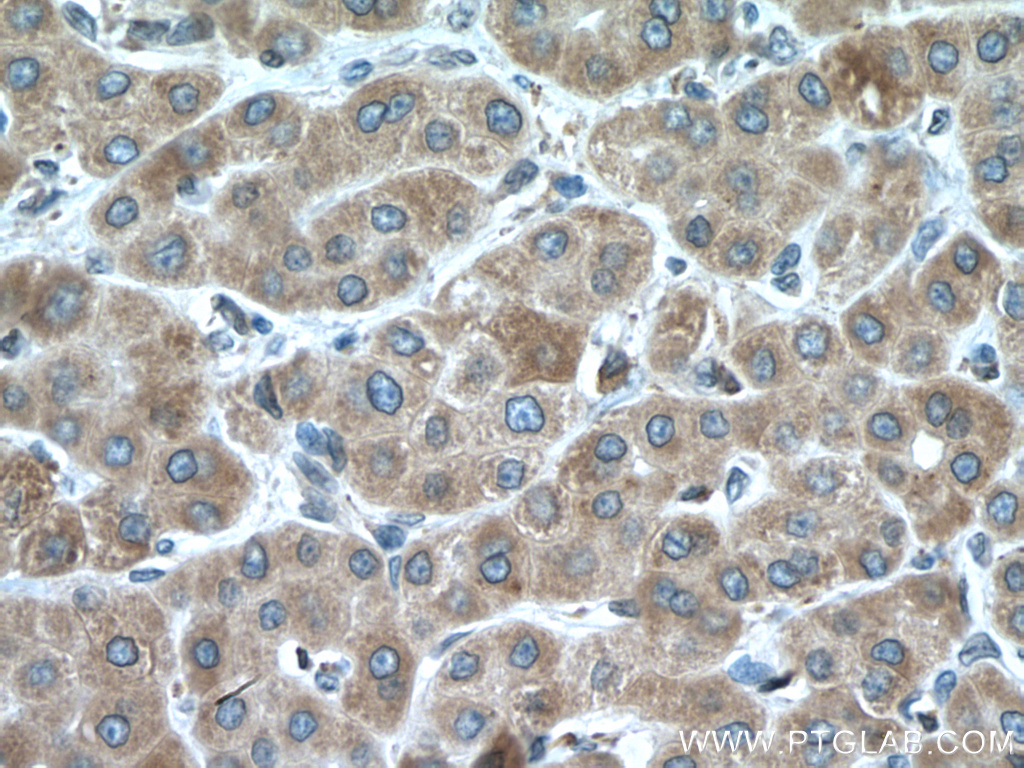 IHC staining of human liver cancer using 19937-1-AP