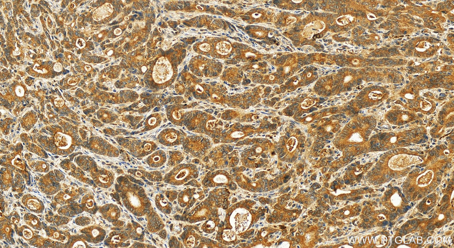 IHC staining of human stomach cancer using 13654-1-AP