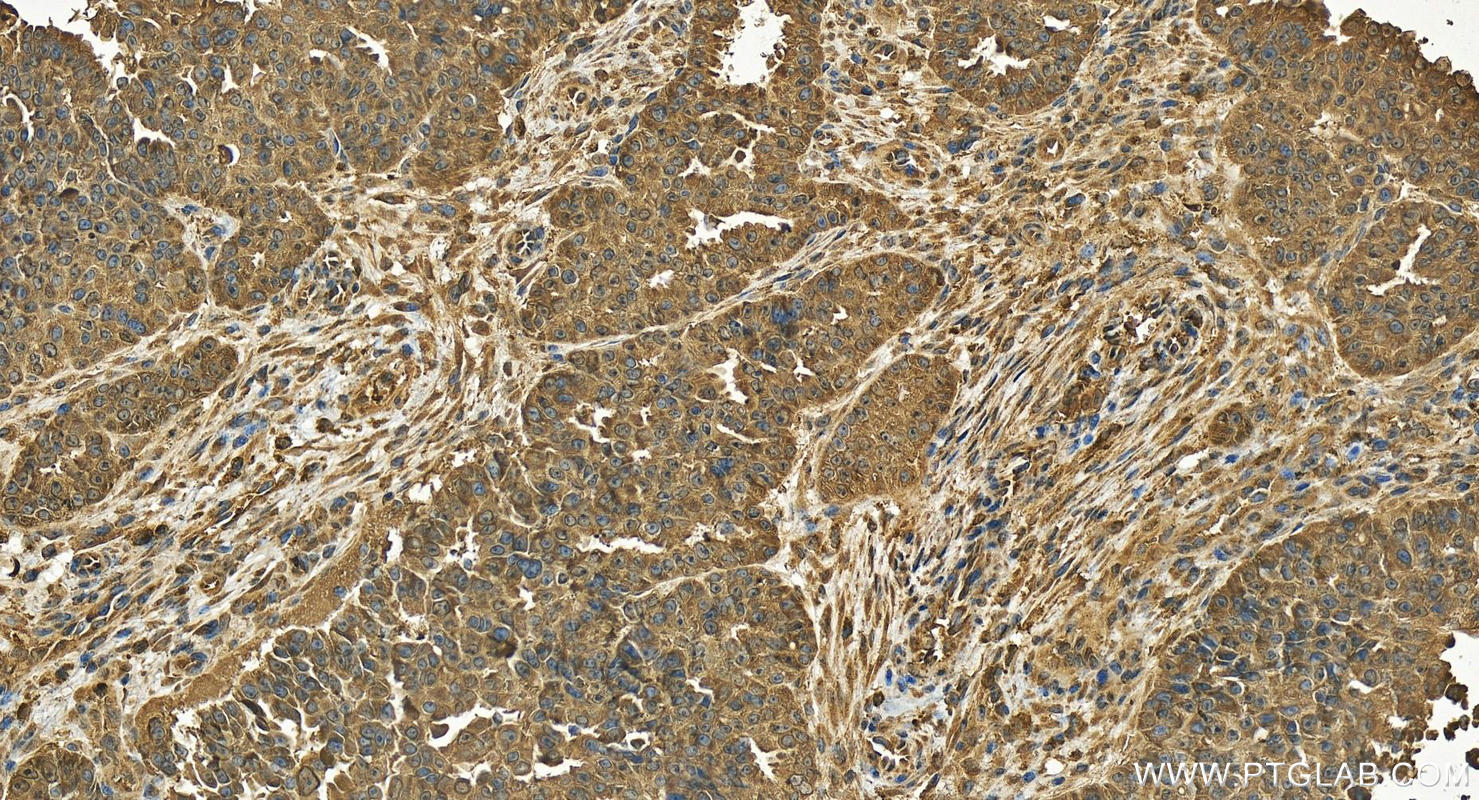 IHC staining of human ovarian  cancer using 19100-1-AP